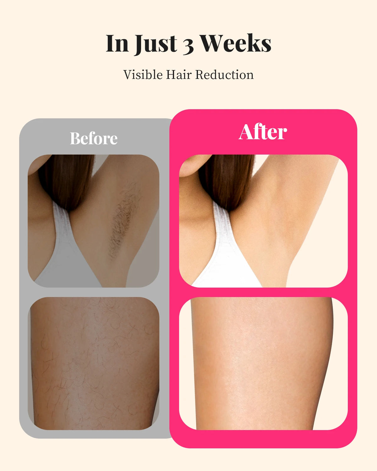990000 Flashes Hair Removal for Women and Men IPL