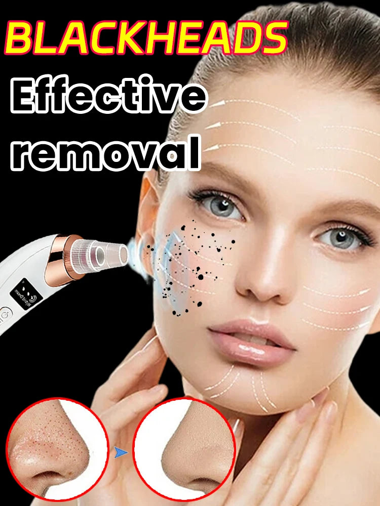 Facial Skin Care Pore Removal Cleanser Vacuum Black Spots Removal For Deep Facial Pores 5 Suction Power Blackhead Remover Pore