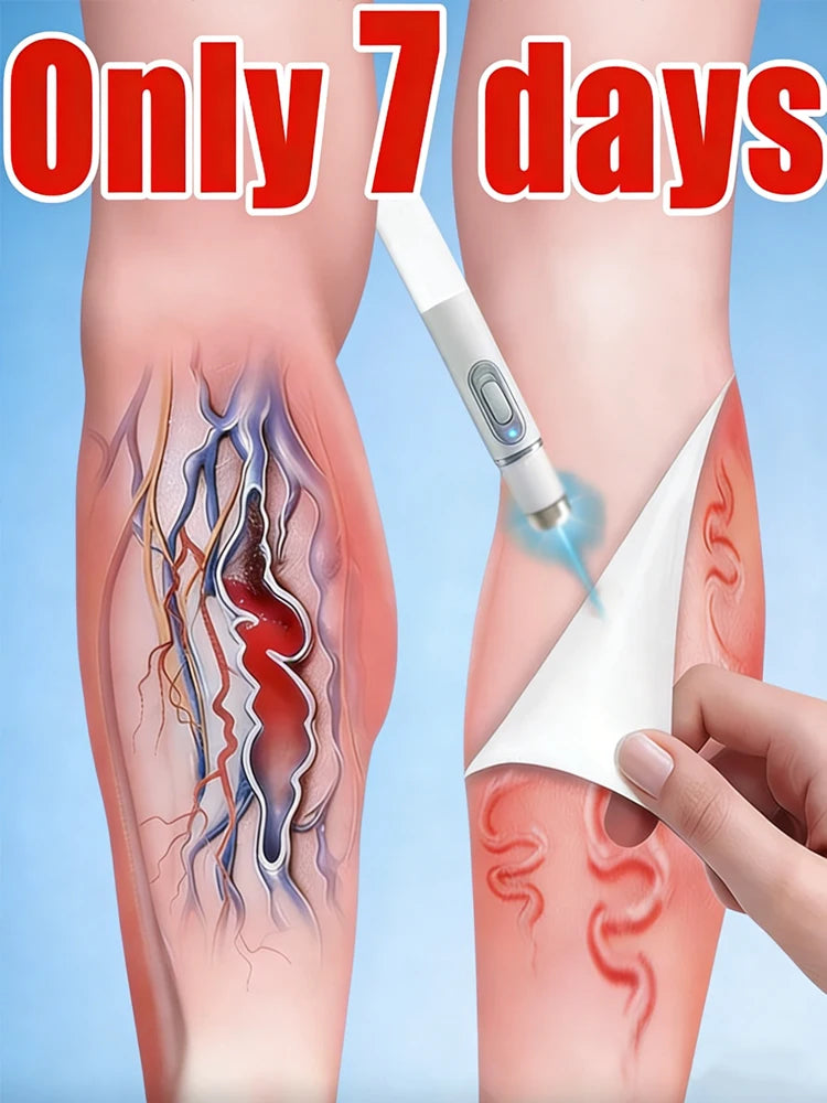 Blue Light Pen for Treating Veins in Both Legs, Vein Care Tool